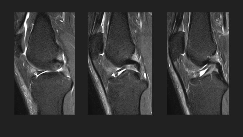 Figure 2 for case meniscofemoral ligament ( RID2806 )